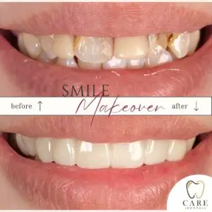 Smile Makeover