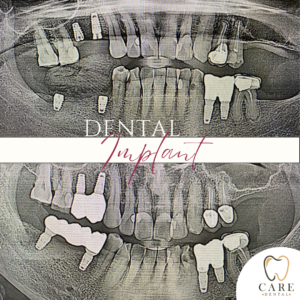 Dental Implant