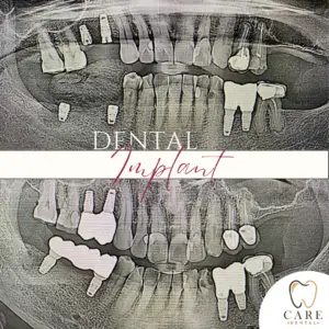 Dental Implant